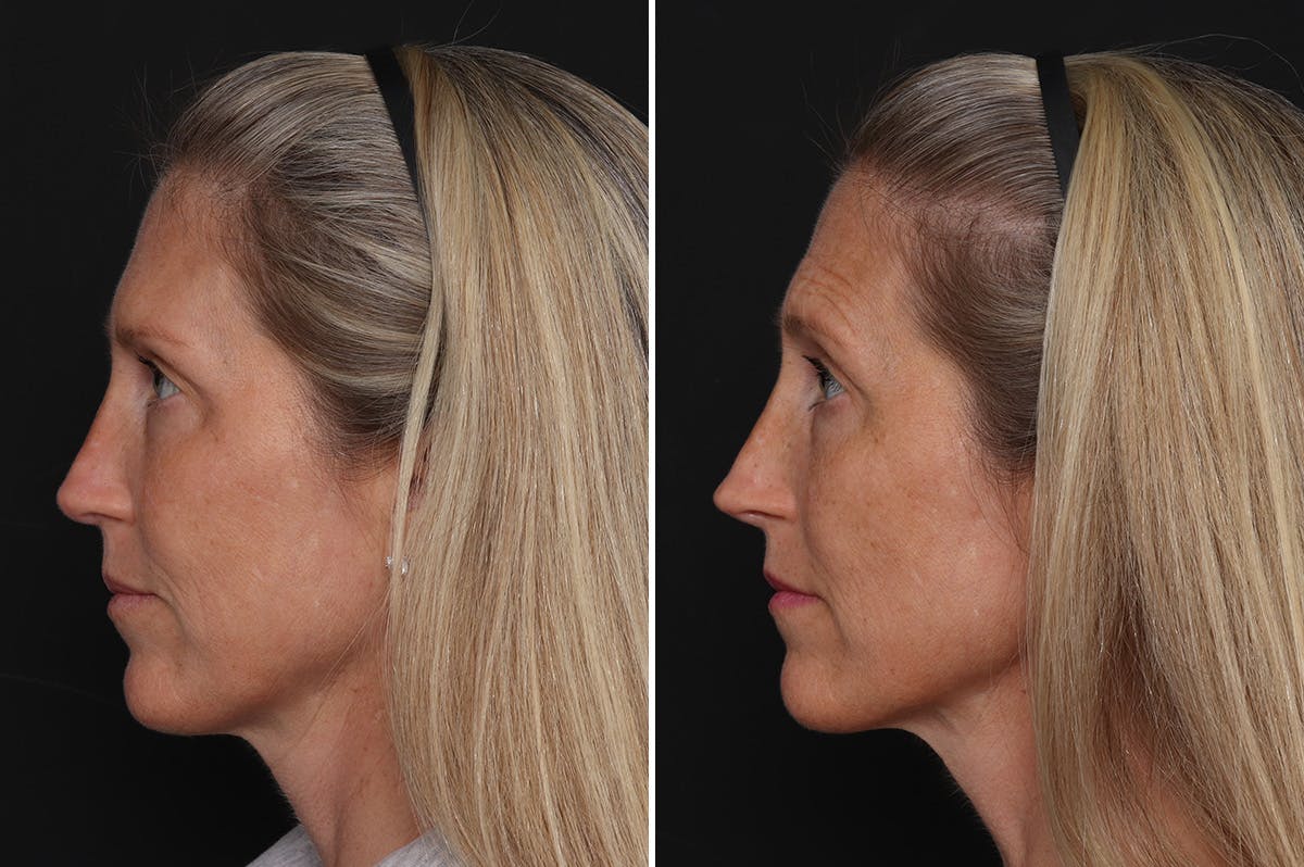 Revision Rhinoplasty Before & After Gallery - Patient 524398 - Image 1