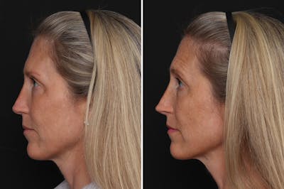 Revision Rhinoplasty Before & After Gallery - Patient 524398 - Image 1