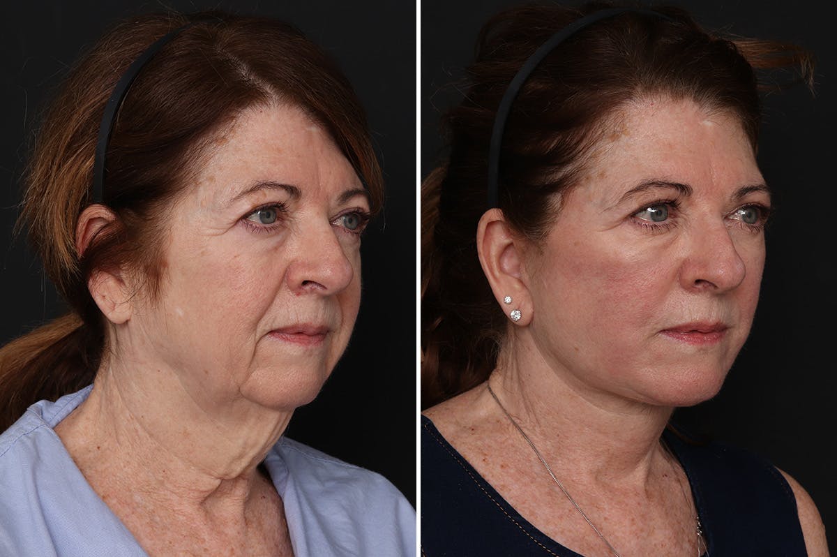 Facelift Before & After Gallery - Patient 370033 - Image 4