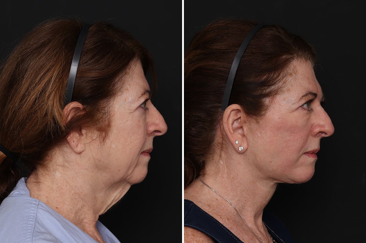 Facelift Before & After Gallery - Patient 370033 - Image 5
