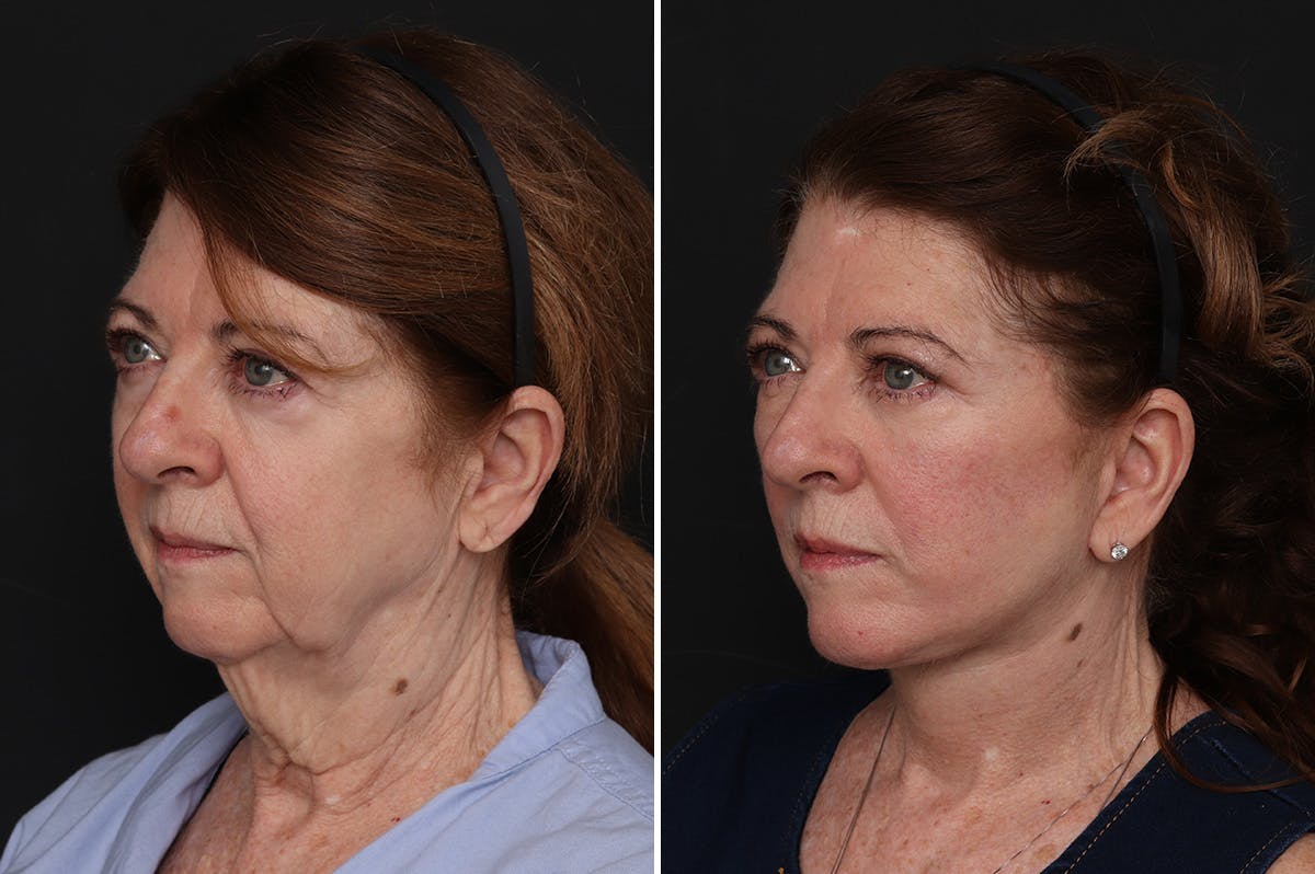 Facelift Before & After Gallery - Patient 370033 - Image 2