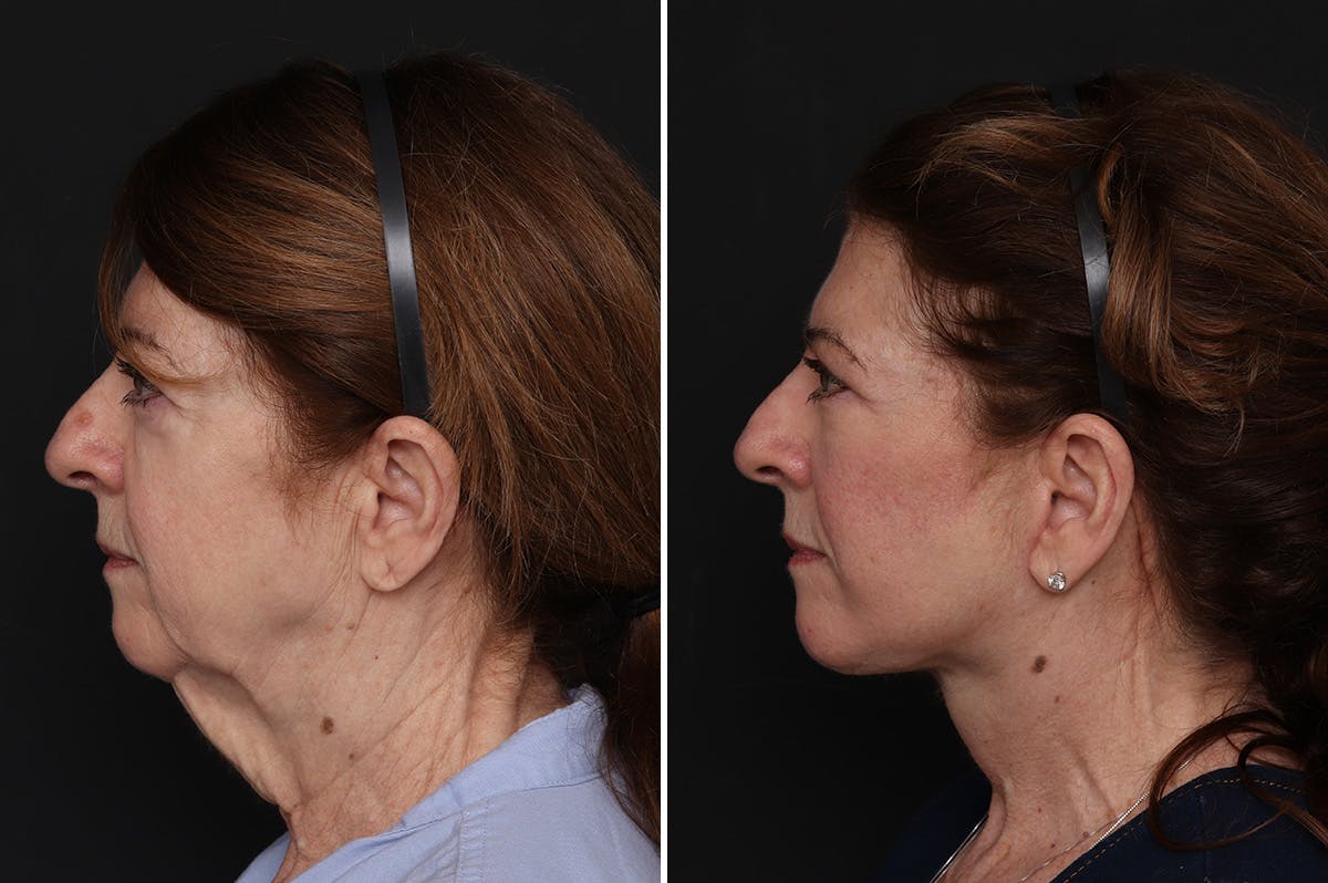 Facelift Before & After Gallery - Patient 370033 - Image 1