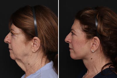 Facelift Before & After Gallery - Patient 370033 - Image 1