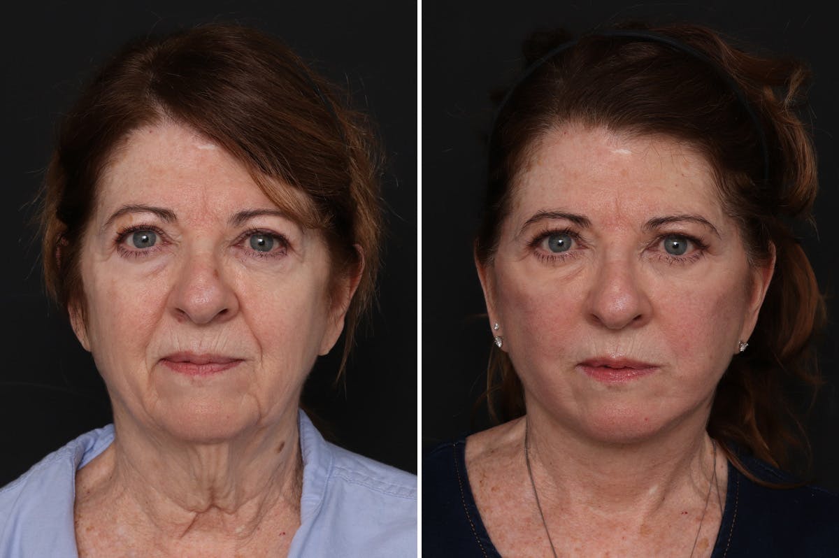 Facelift Before & After Gallery - Patient 370033 - Image 3