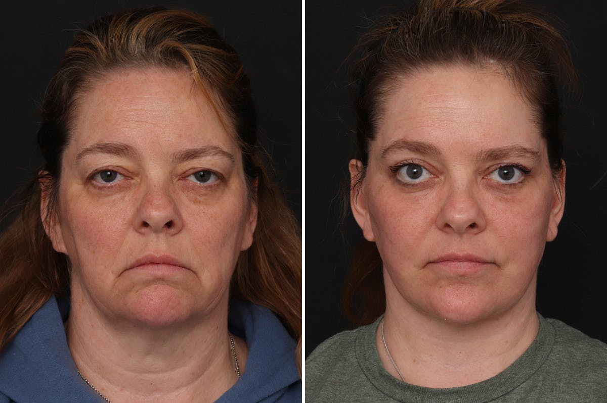 Upper Eyelid Before & After Gallery - Patient 278993 - Image 3