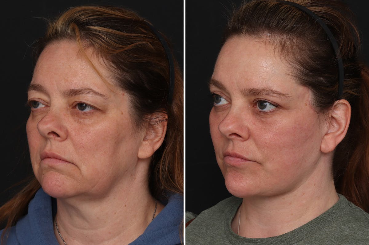 Upper Eyelid Before & After Gallery - Patient 278993 - Image 1