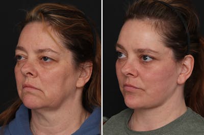 Upper Eyelid Before & After Gallery - Patient 278993 - Image 1