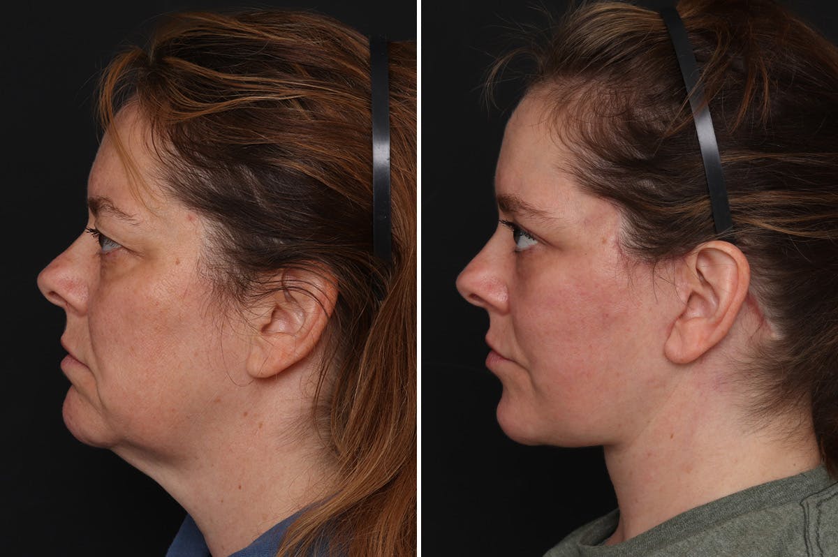 Upper Eyelid Before & After Gallery - Patient 278993 - Image 2