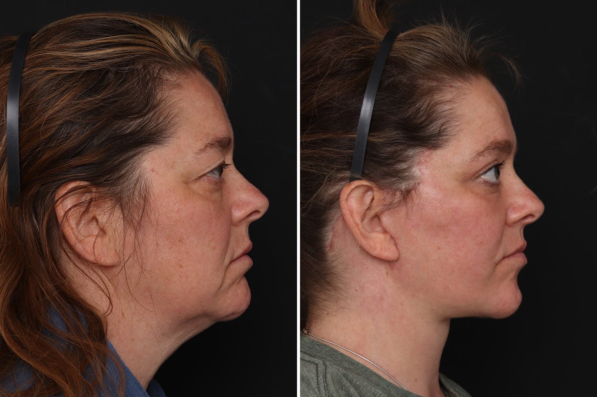 Upper Eyelid Before & After Gallery - Patient 278993 - Image 4