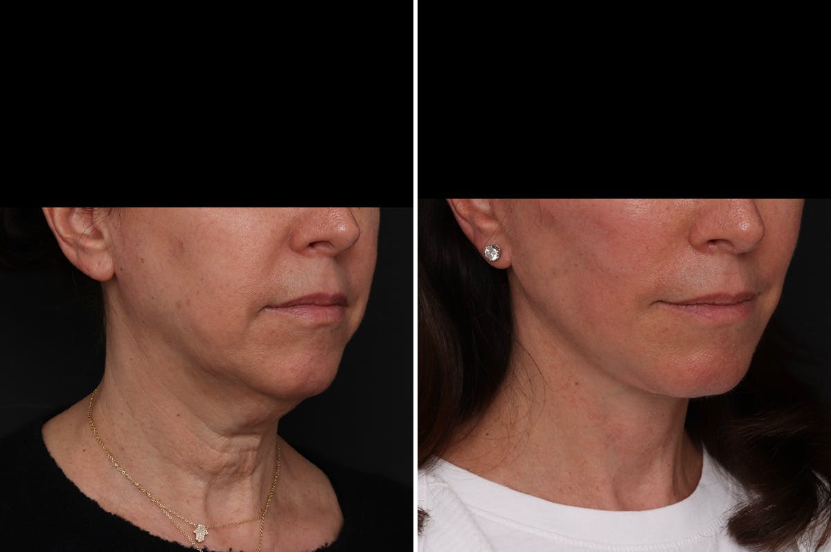 Facelift Before & After Gallery - Patient 161096 - Image 2