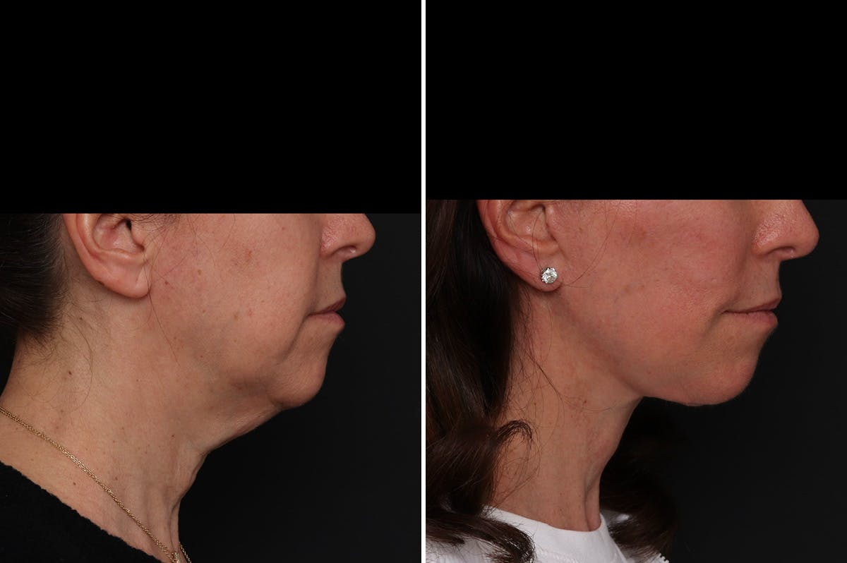 Facelift Before & After Gallery - Patient 161096 - Image 3