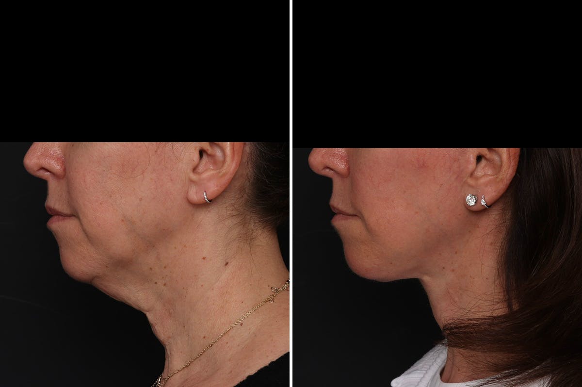 Facelift Before & After Gallery - Patient 161096 - Image 1