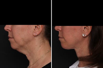 Facelift Before & After Gallery - Patient 161096 - Image 1