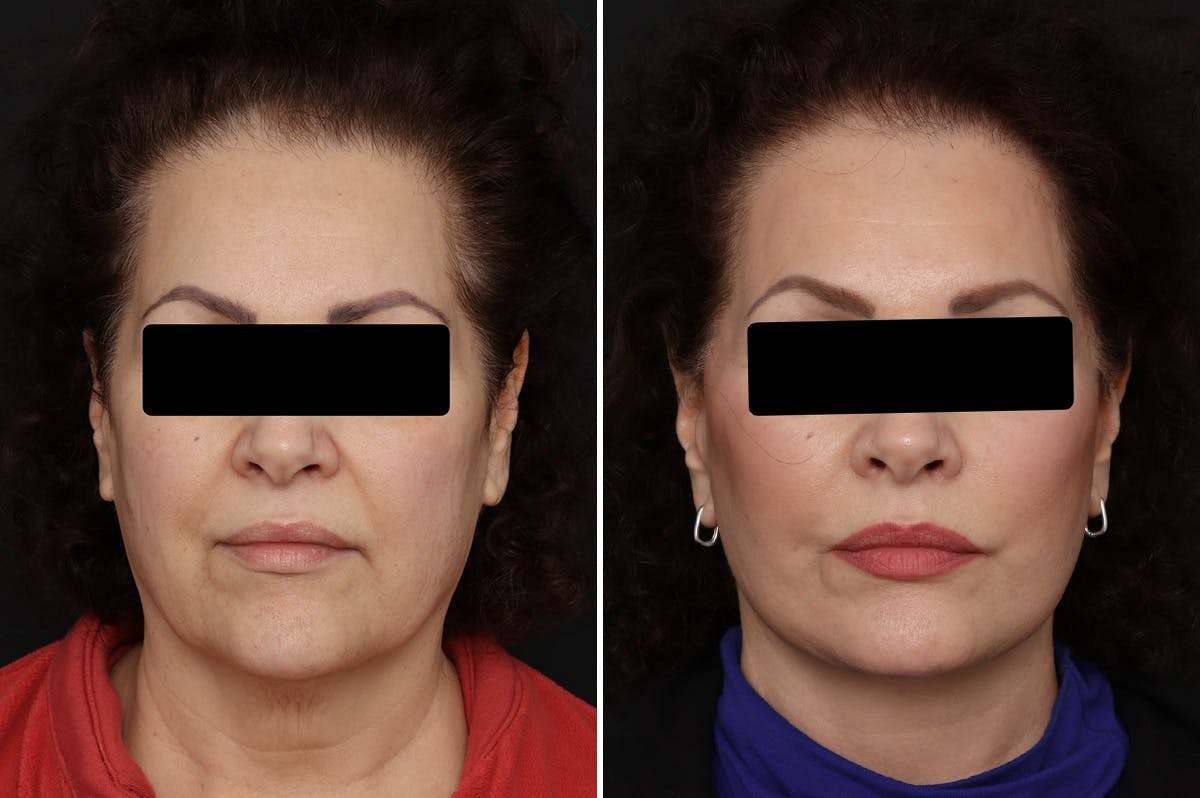Facelift Before & After Gallery - Patient 150742 - Image 3