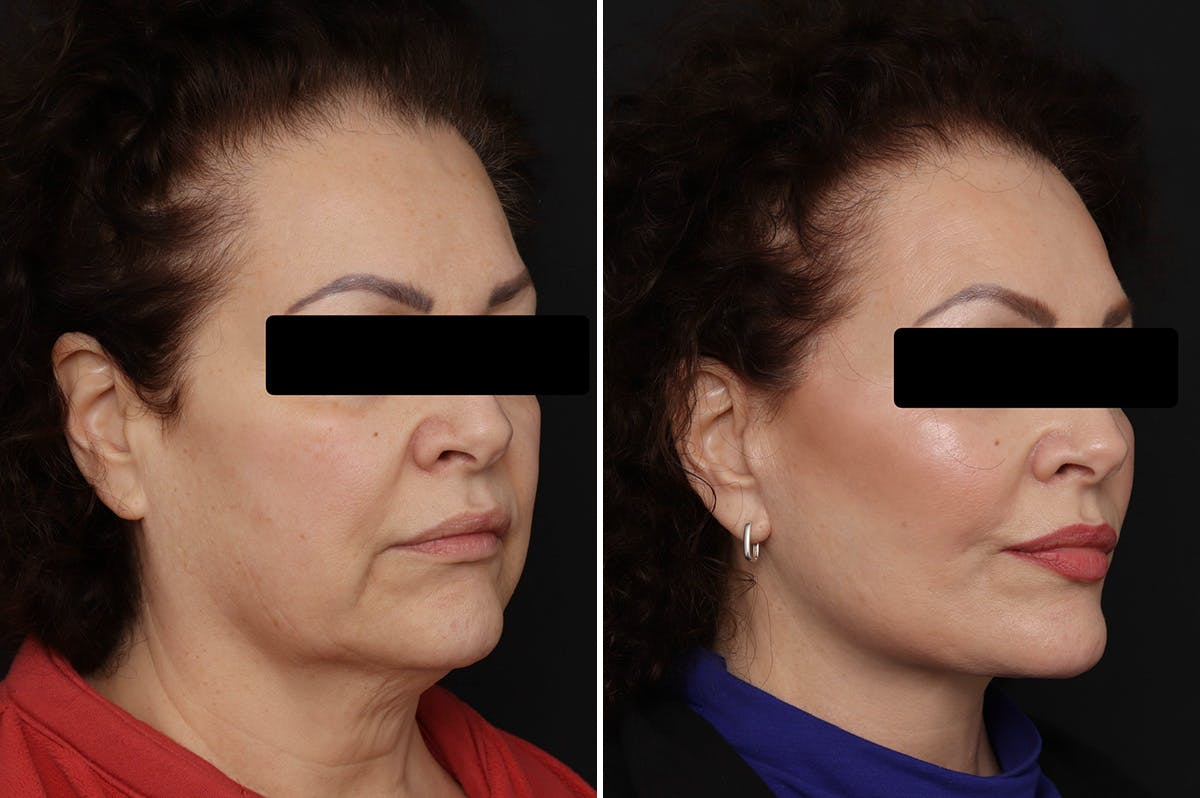 Facelift Before & After Gallery - Patient 150742 - Image 4