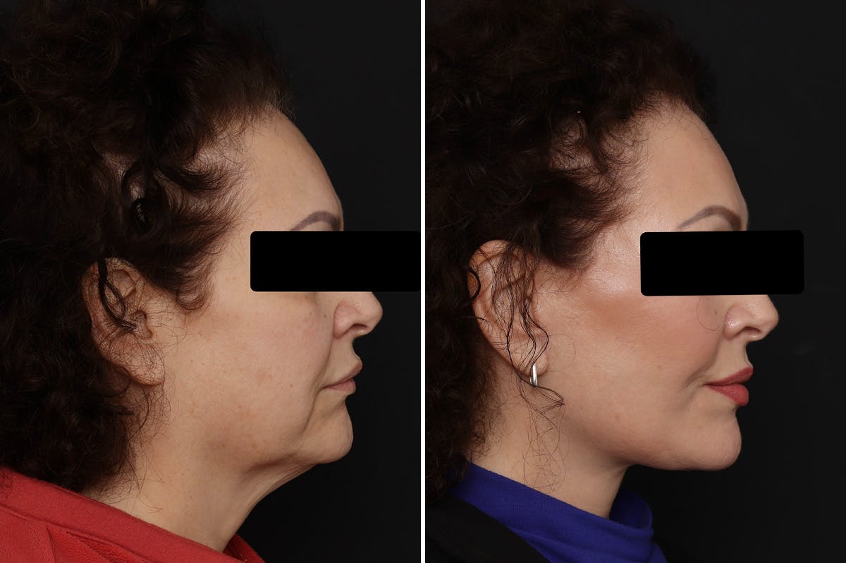 Facelift Before & After Gallery - Patient 150742 - Image 5