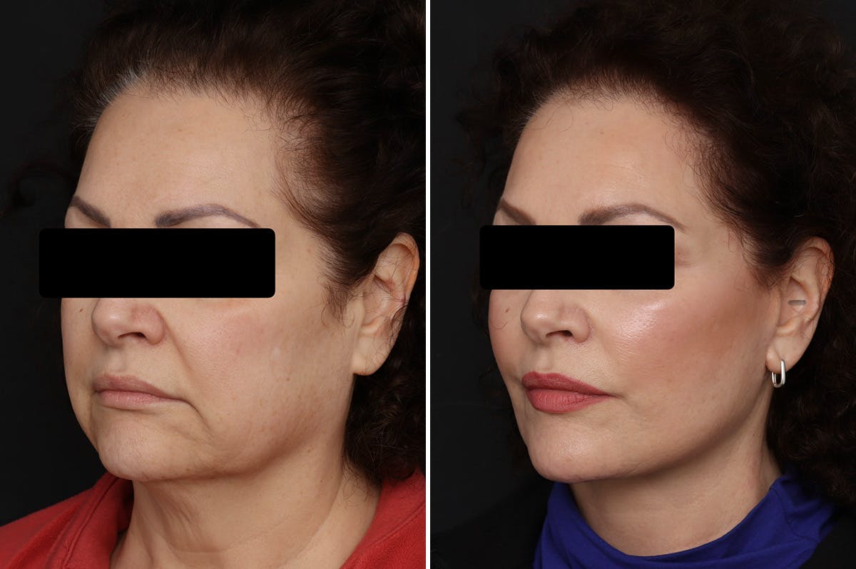 Facelift Before & After Gallery - Patient 150742 - Image 2
