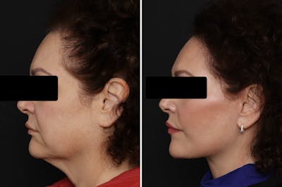 Facelift Before & After Gallery - Patient 150742 - Image 1