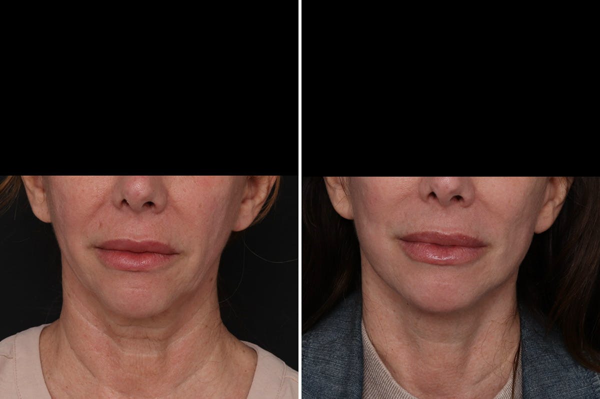 Facelift Before & After Gallery - Patient 396843 - Image 3