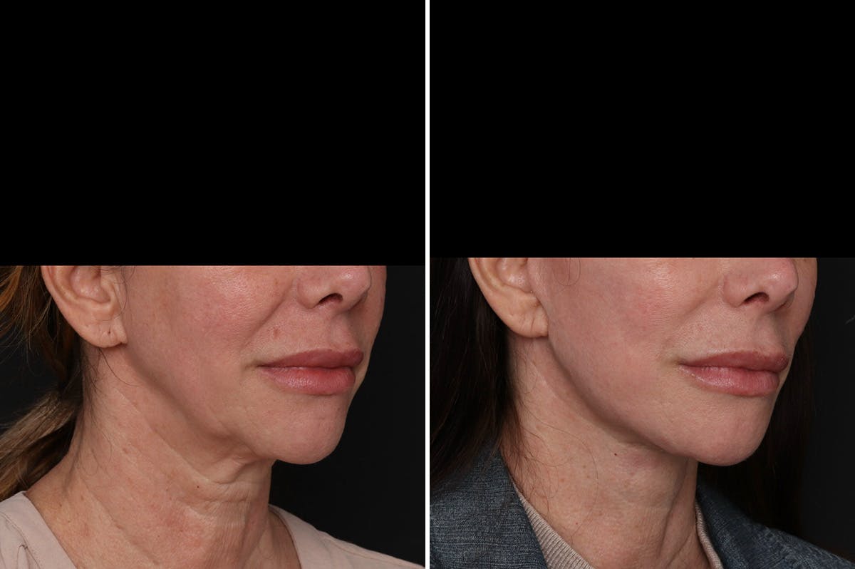 Facelift Before & After Gallery - Patient 396843 - Image 4