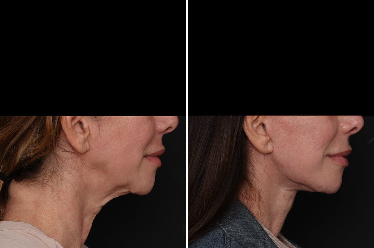 Facelift Before & After Gallery - Patient 396843 - Image 5