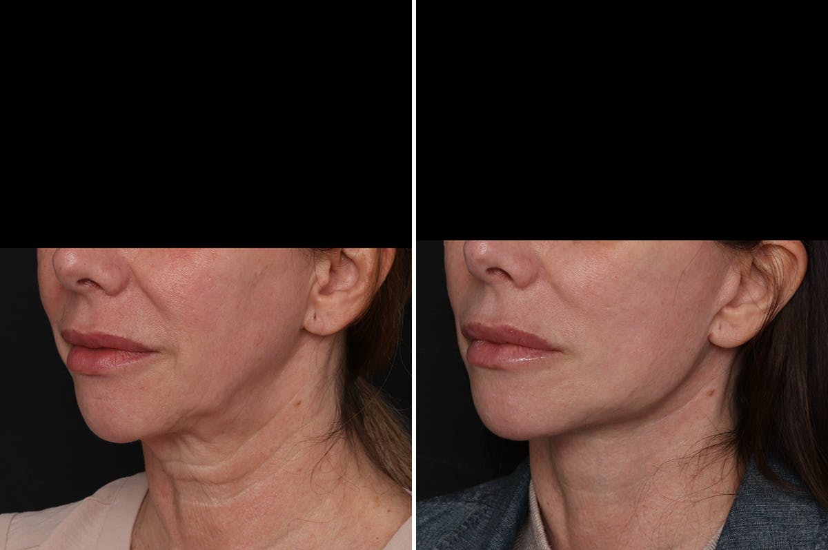 Facelift Before & After Gallery - Patient 396843 - Image 2