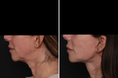 Facelift Before & After Gallery - Patient 396843 - Image 1
