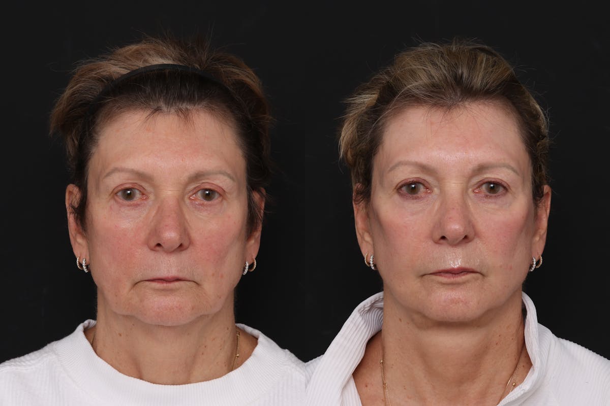 Facelift Before & After Gallery - Patient 370204 - Image 3