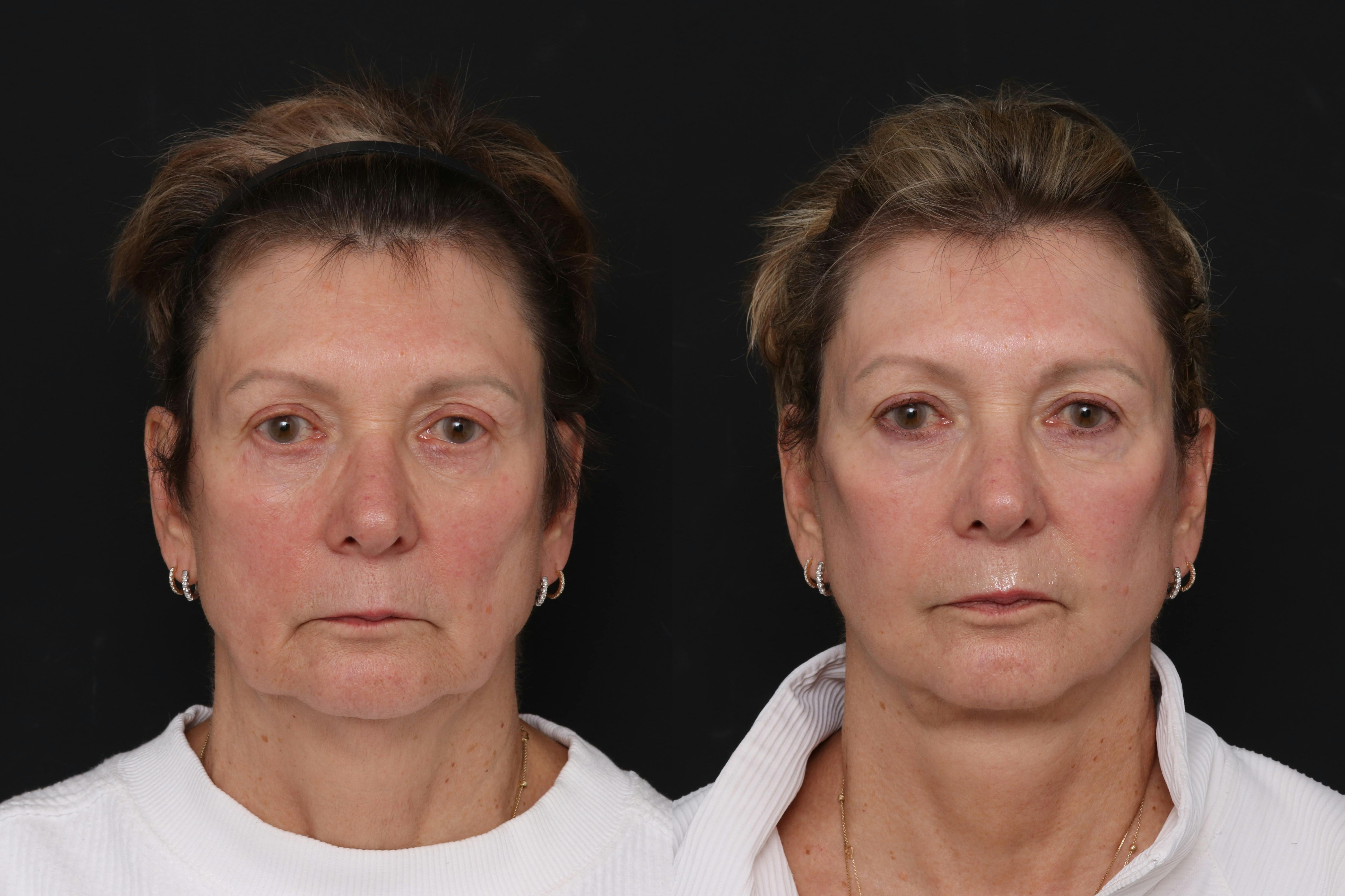 Facelift