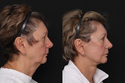 Facelift Before & After Gallery - Patient 370204 - Image 1