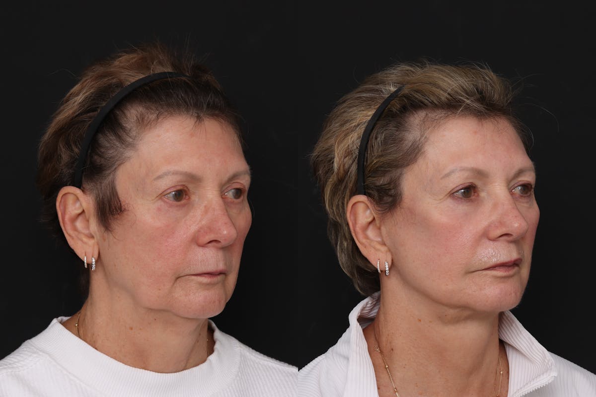 Facelift Before & After Gallery - Patient 370204 - Image 2