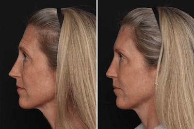 Revision Rhinoplasty Before & After Gallery - Patient 524398 - Image 1