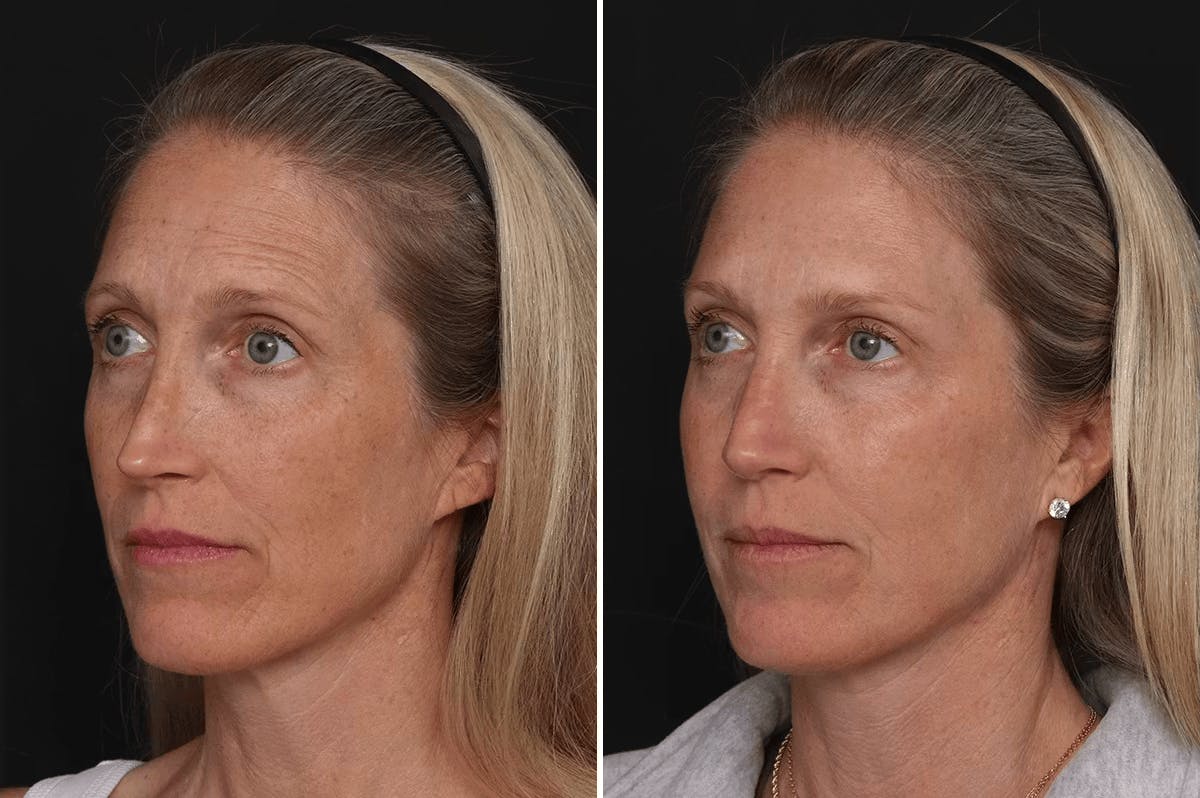 Revision Rhinoplasty Before & After Gallery - Patient 524398 - Image 2