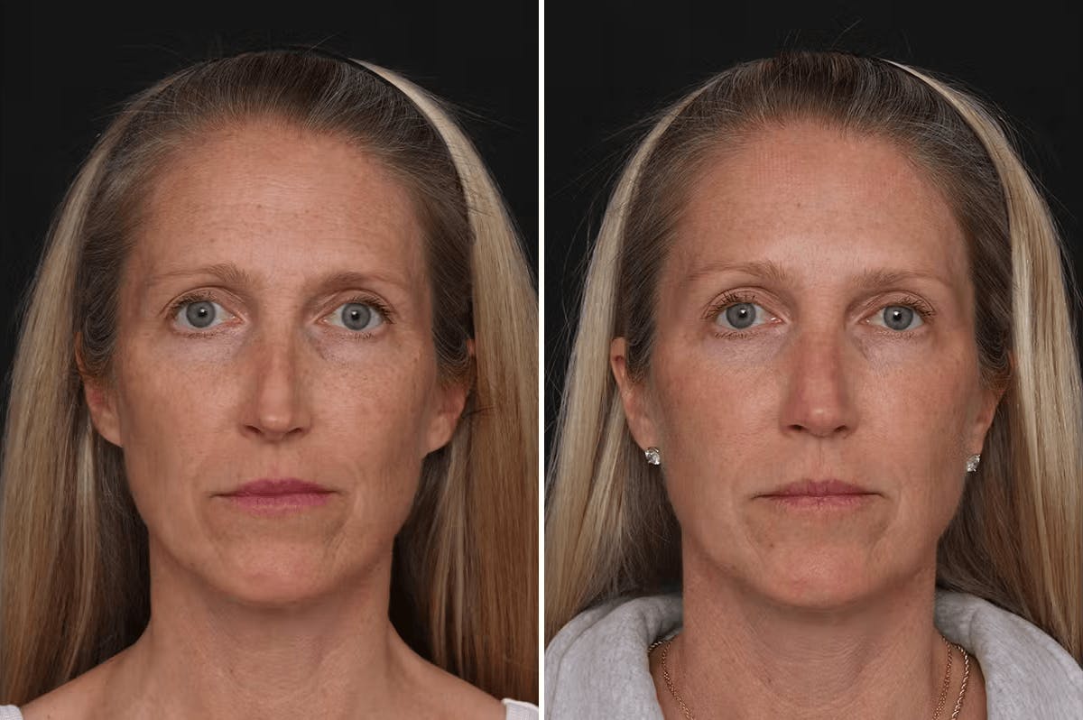 Revision Rhinoplasty Before & After Gallery - Patient 524398 - Image 3