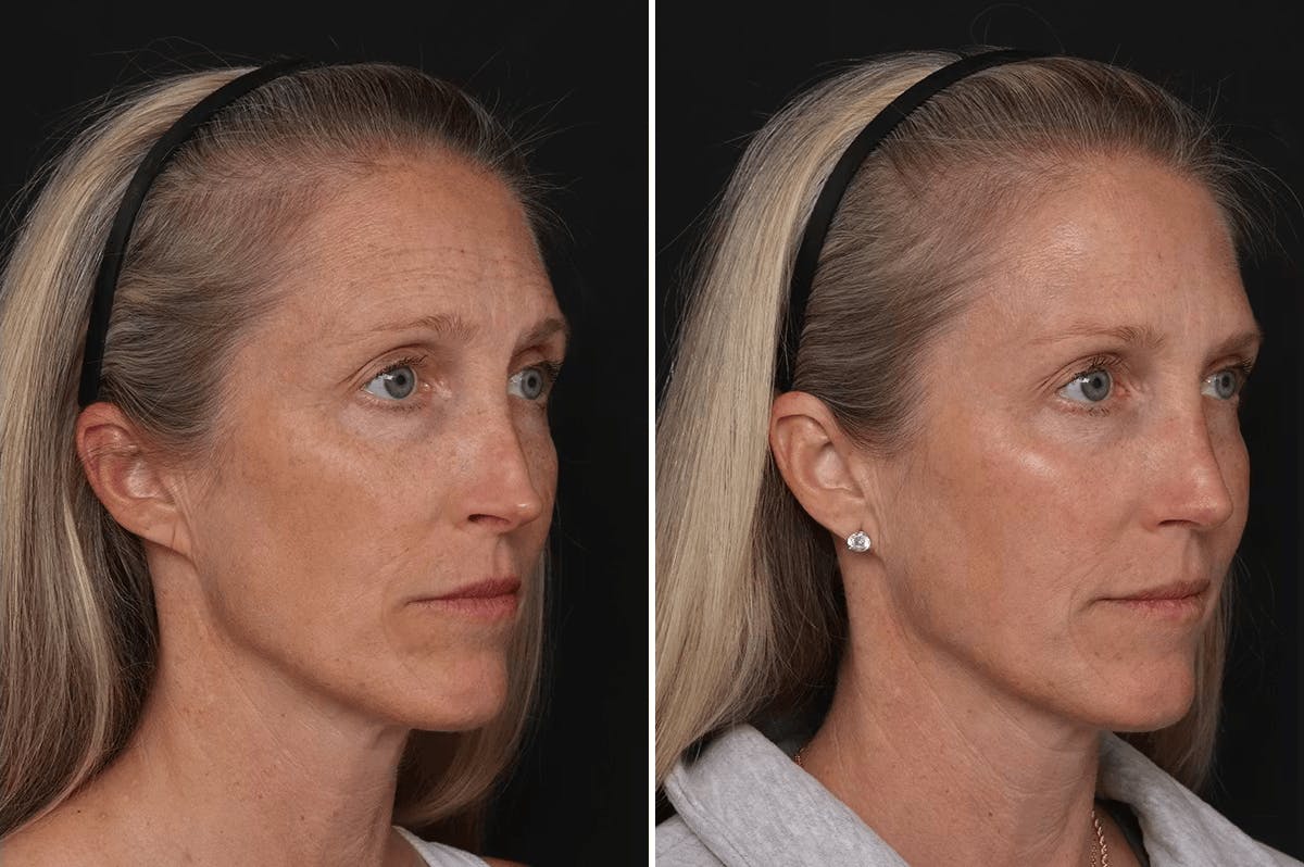 Revision Rhinoplasty Before & After Gallery - Patient 524398 - Image 4