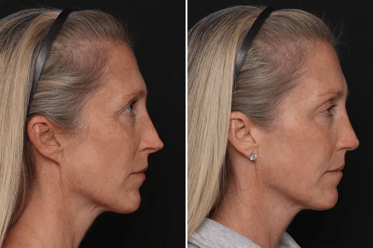 Revision Rhinoplasty Before & After Gallery - Patient 524398 - Image 5