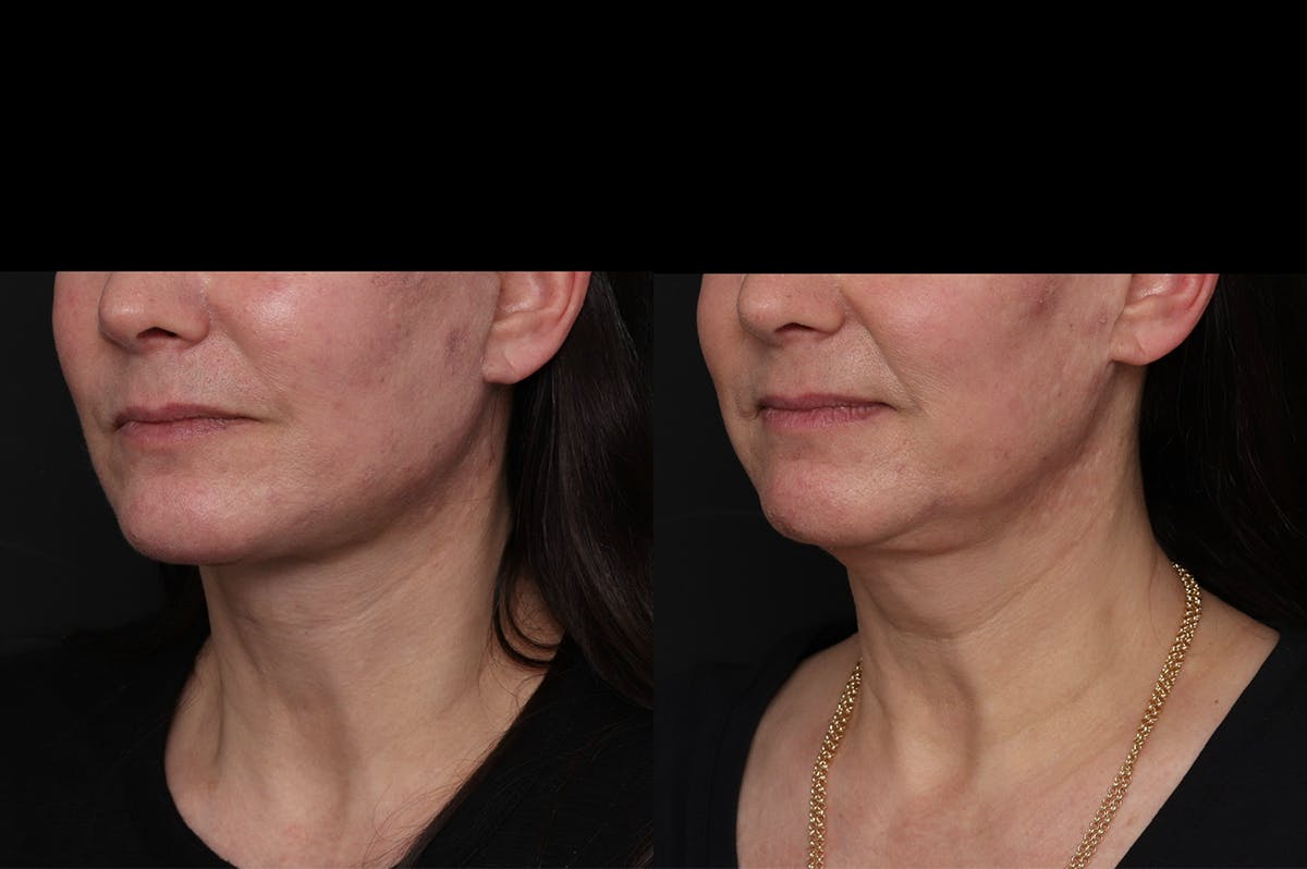 Revision Facelift Before & After Gallery - Patient 976706 - Image 2