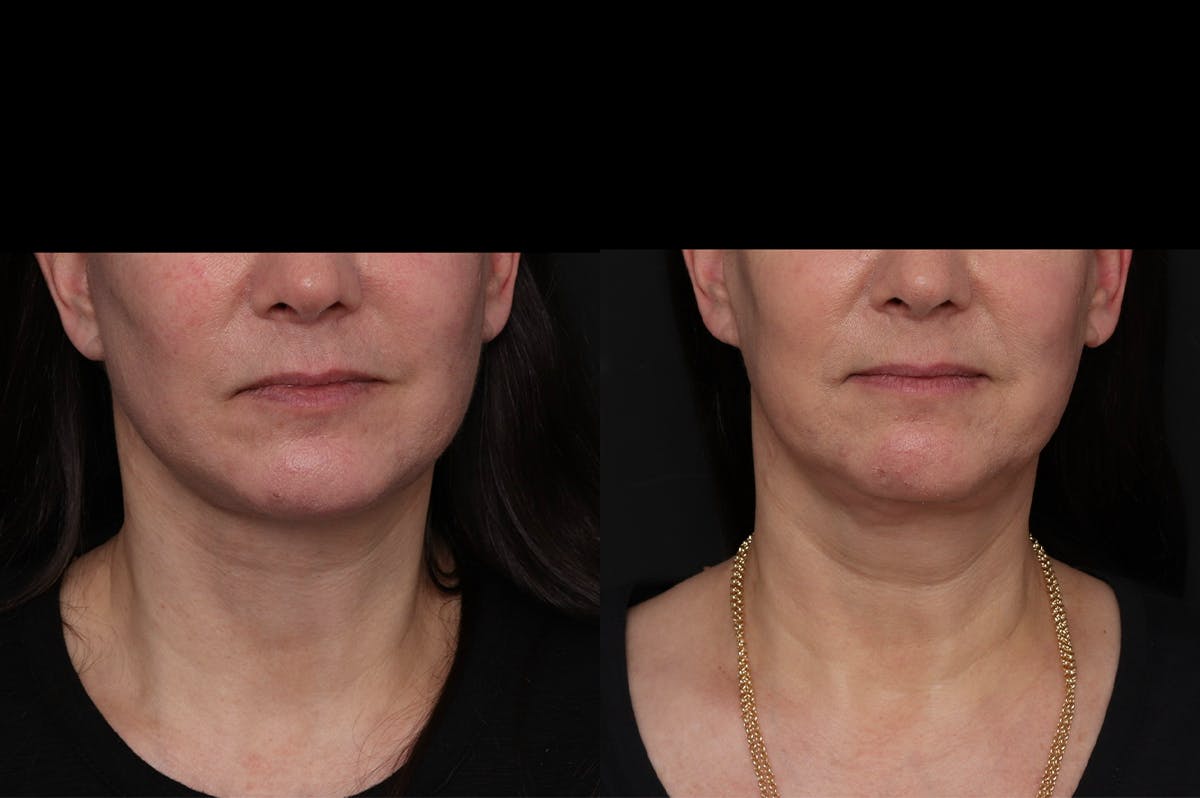 Revision Facelift Before & After Gallery - Patient 976706 - Image 3