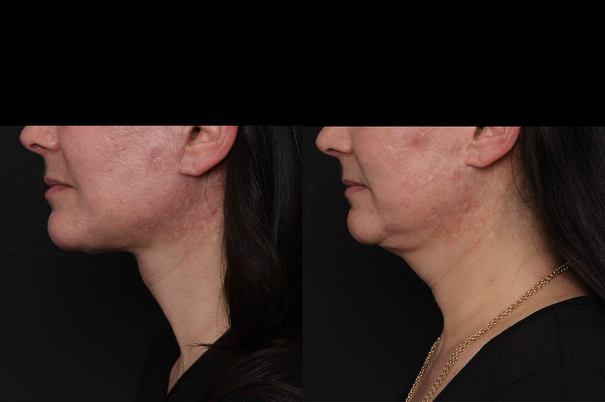 Revision Facelift Before & After Gallery - Patient 976706 - Image 1