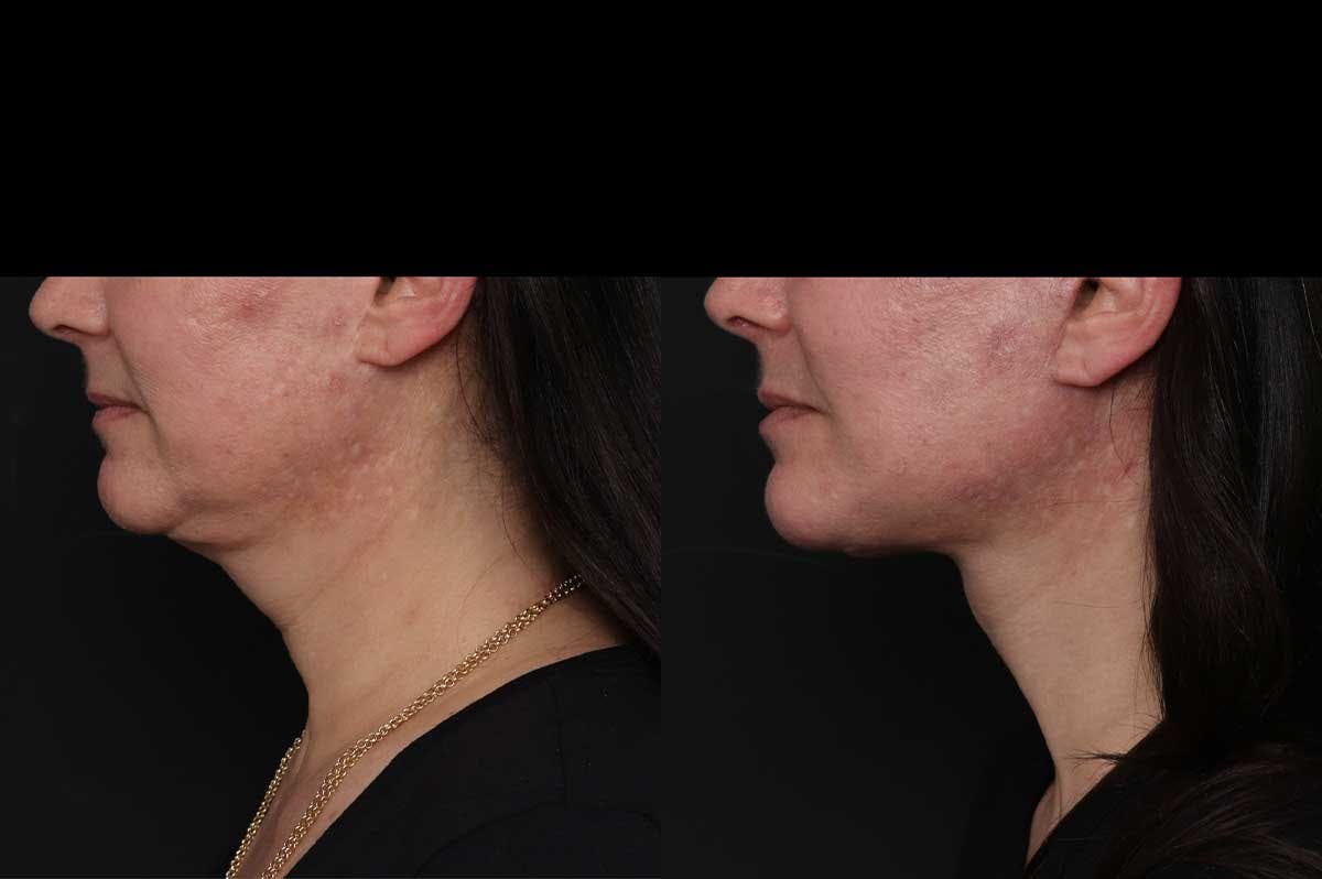 Revision Facelift Before & After Gallery - Patient 976706 - Image 1
