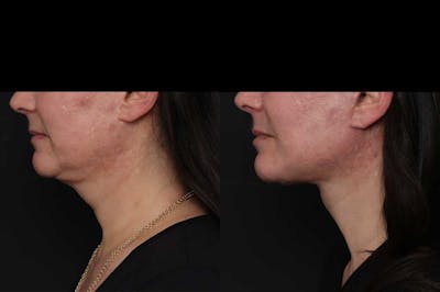 Revision Facelift Before & After Gallery - Patient 976706 - Image 1