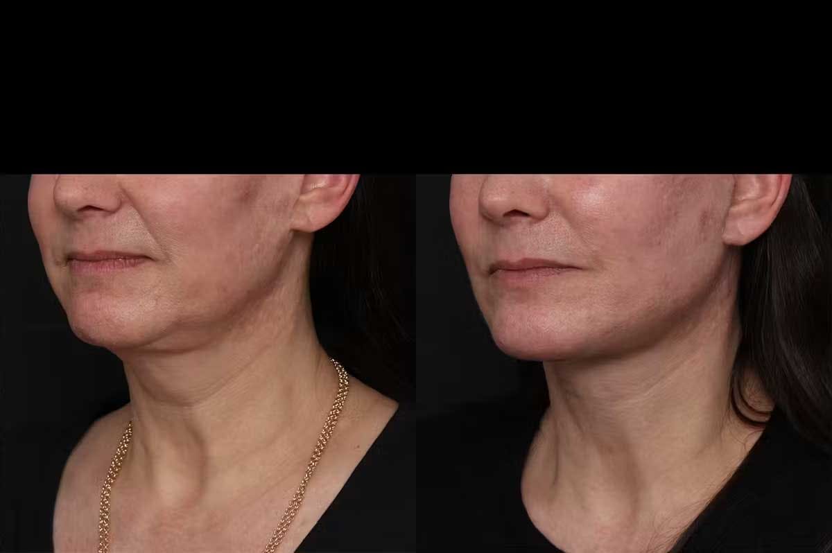 Revision Facelift Before & After Gallery - Patient 976706 - Image 2