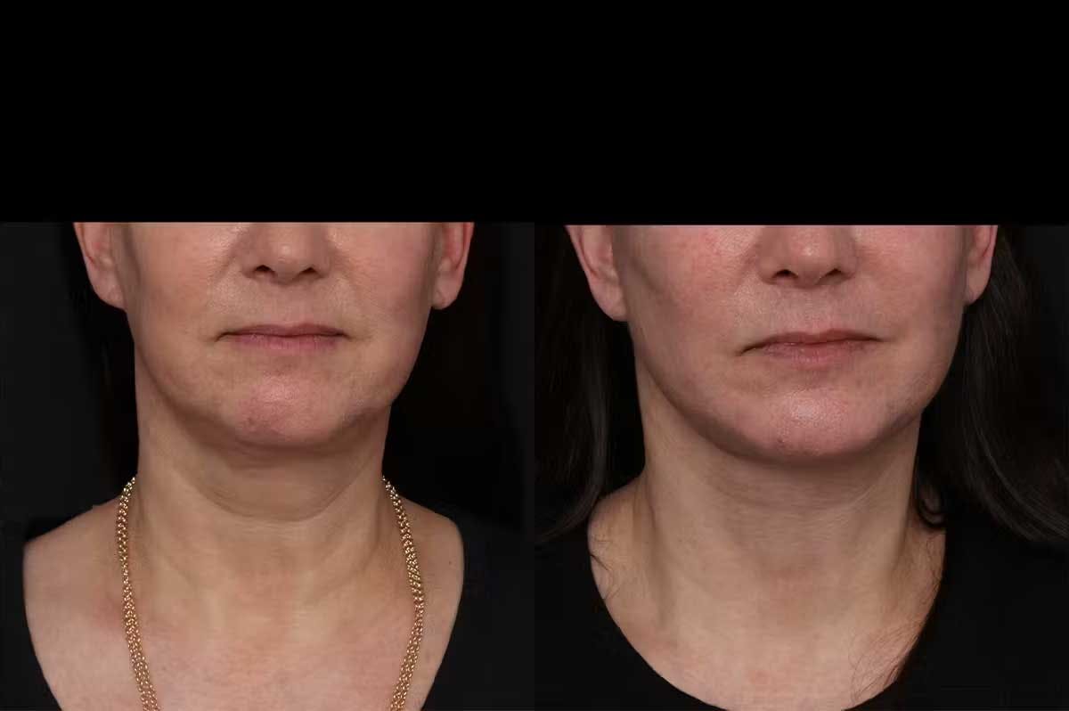 Revision Facelift Before & After Gallery - Patient 976706 - Image 3