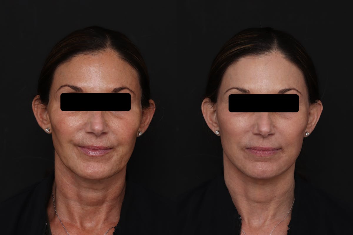Facelift Before & After Gallery - Patient 223142 - Image 4