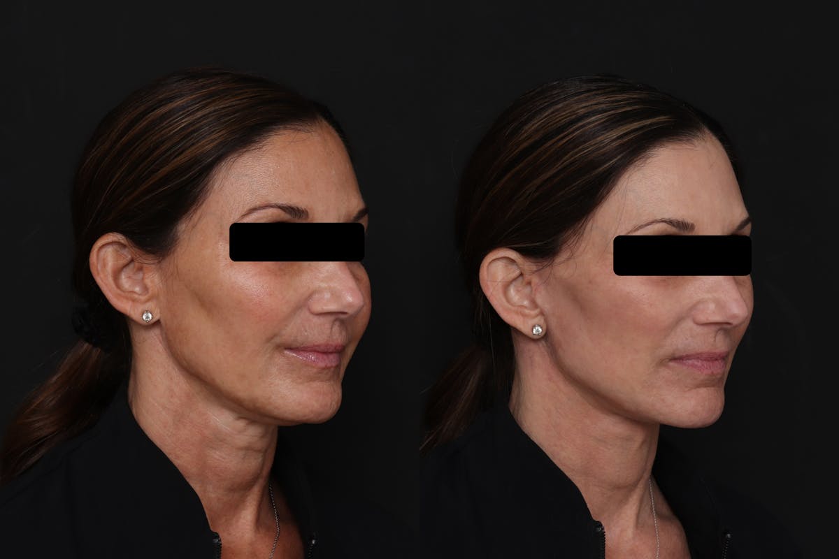 Facelift Before & After Gallery - Patient 223142 - Image 3