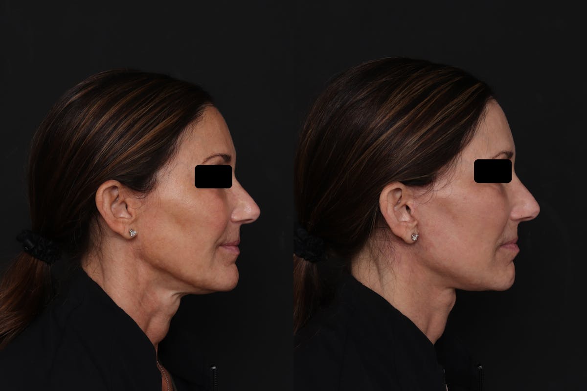 Facelift Before & After Gallery - Patient 223142 - Image 1