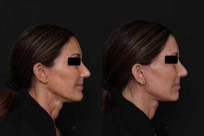 Facelift Before & After Gallery - Patient 223142 - Image 1
