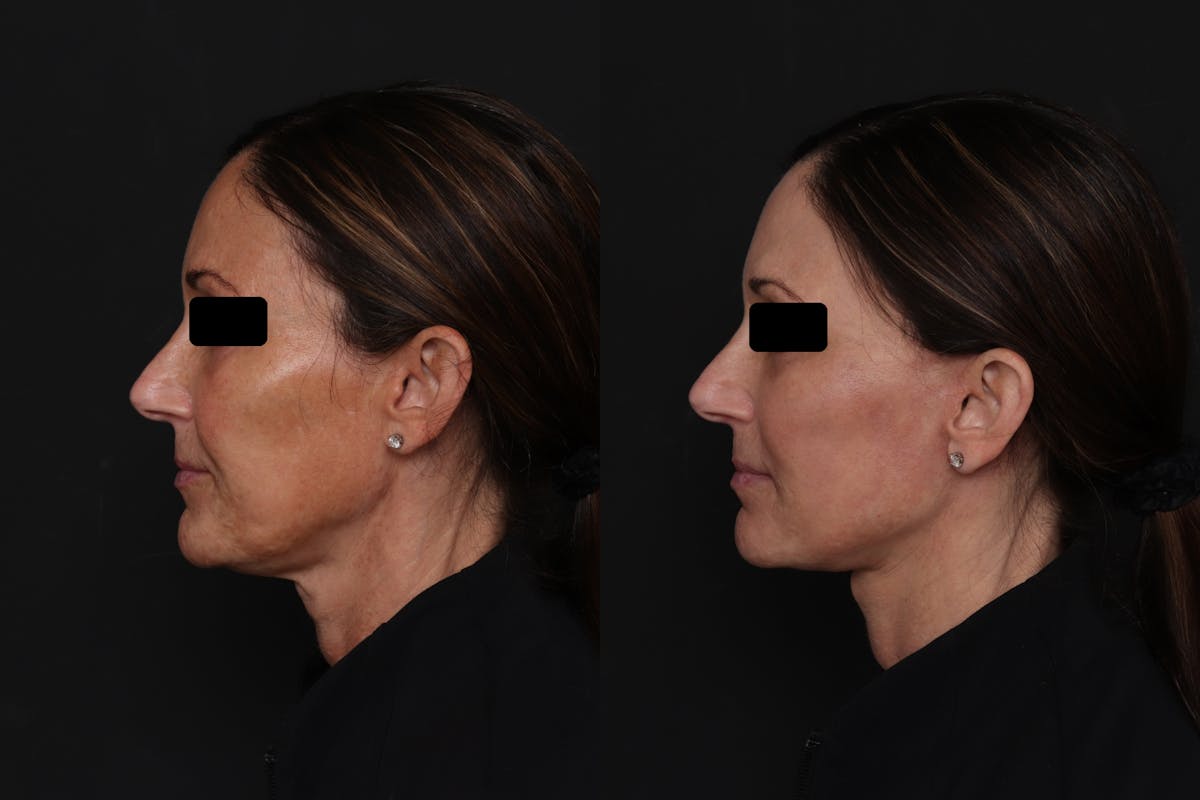 Facelift Before & After Gallery - Patient 223142 - Image 2