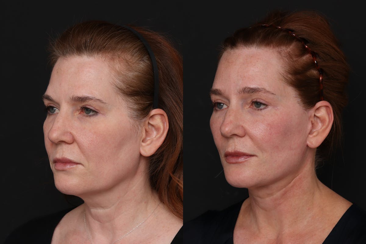 Facelift Before & After Gallery - Patient 174700 - Image 2