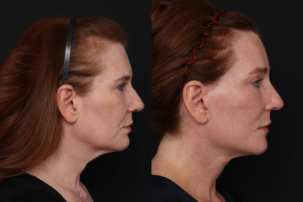 Facelift Before & After Gallery - Patient 174700 - Image 1